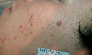 Before - Before and after acne treatment at Mode Laser Skin Clinic