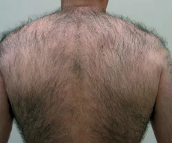 Hair before laser treatment