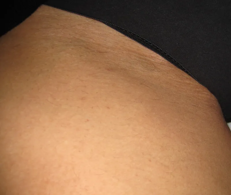 After - Before and after bikini area laser hair reduction at Mode Laser Skin Clinic