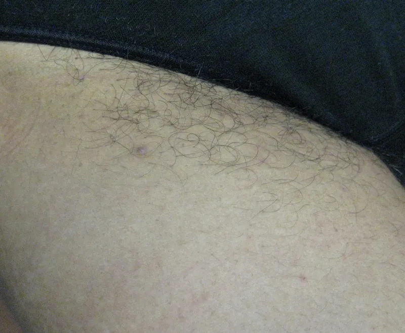 Before - Before and after bikini area laser hair reduction at Mode Laser Skin Clinic