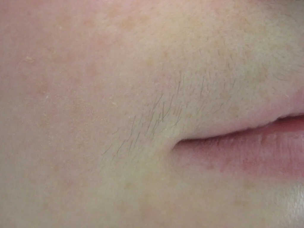 Upper lip hair before treatment