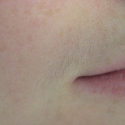 Before - Before and after showing lip hair removal results at Mode Laser Skin Clinic