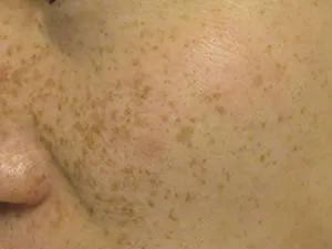 Pigmentation significantly faded after treatment