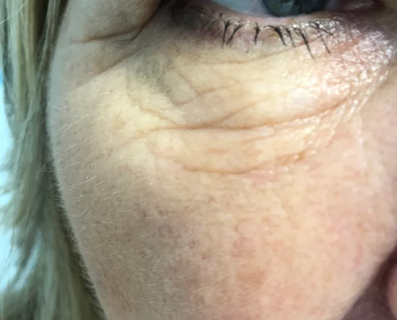 After - Before and after pigmentation removal treatment at Mode Laser Skin Clinic