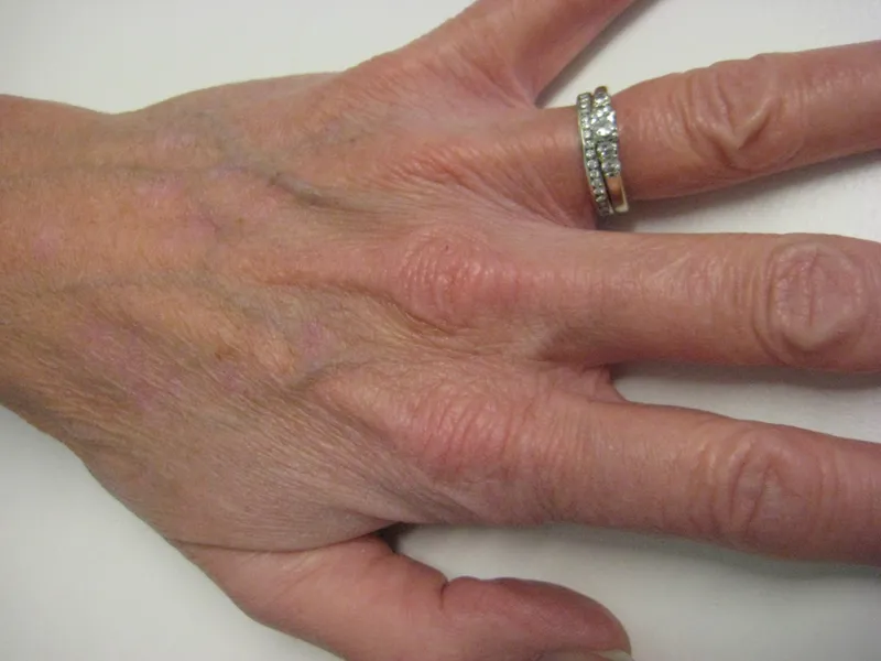 After - Before and after pigmentation treatment showing cleared skin