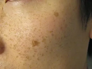 Pigmentation before IPL treatment