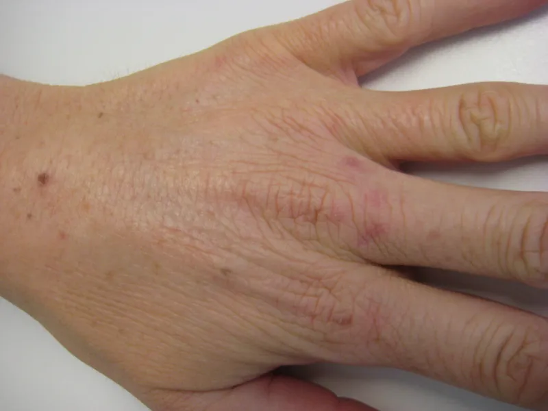 Before - Before and after pigmentation treatment showing cleared skin