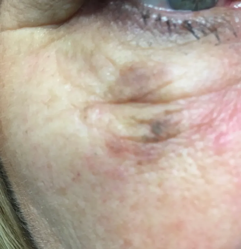 Pigmentation before treatment