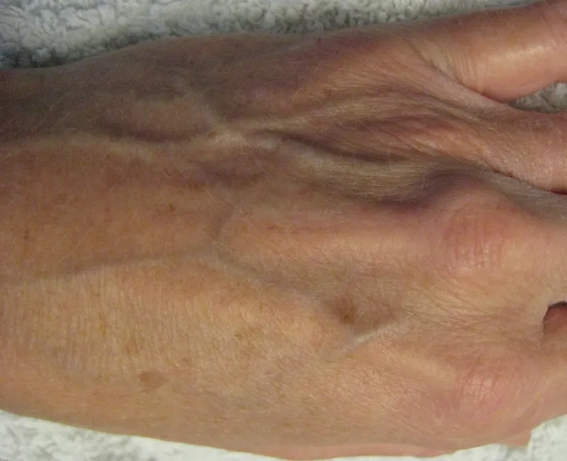 Before - Before and after pigmentation removal at Mode Laser Skin Clinic