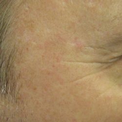 After - Before and after showing faded pigmentation at Mode Laser Skin Clinic
