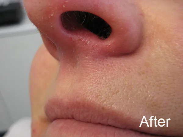 Veins eliminated after 1 session