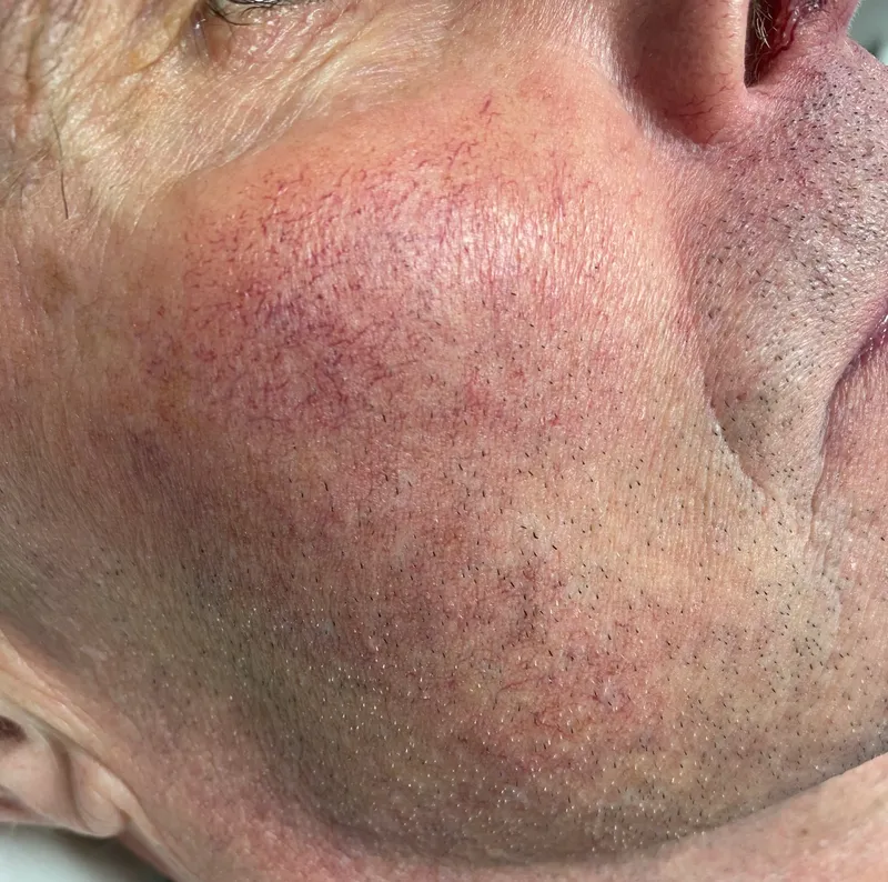 Before - Before and after capillary treatment showing cleared skin