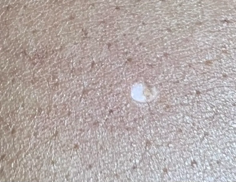 Immediately after skin tag removal