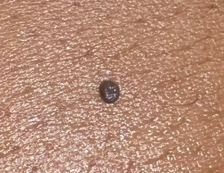 Before - Before and immediately after skin tag removal at Mode Laser Skin Clinic