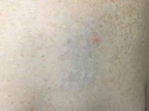 Tattoo faded after laser treatment