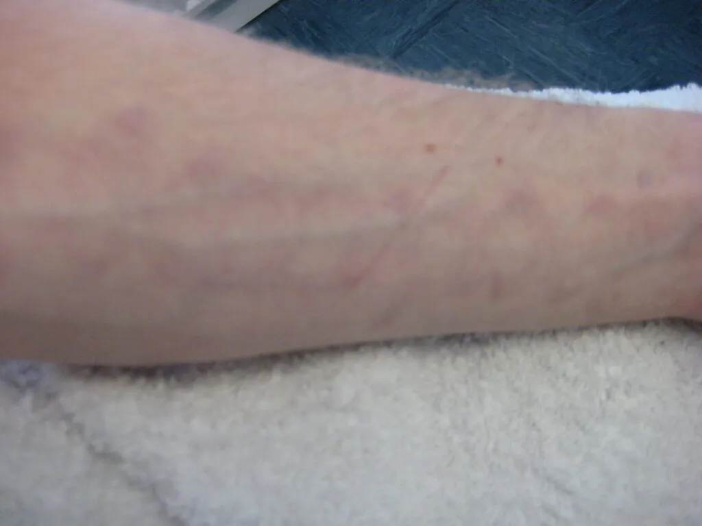 Tattoo after laser removal sessions