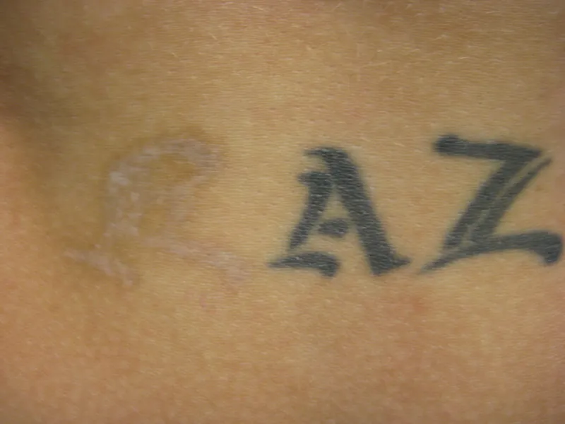 After - Before and after tattoo removal showing progress after 4 sessions