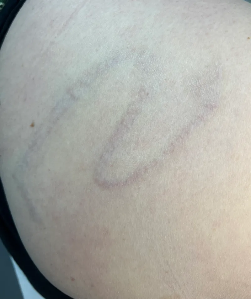 Tattoo after 11 sessions of laser removal