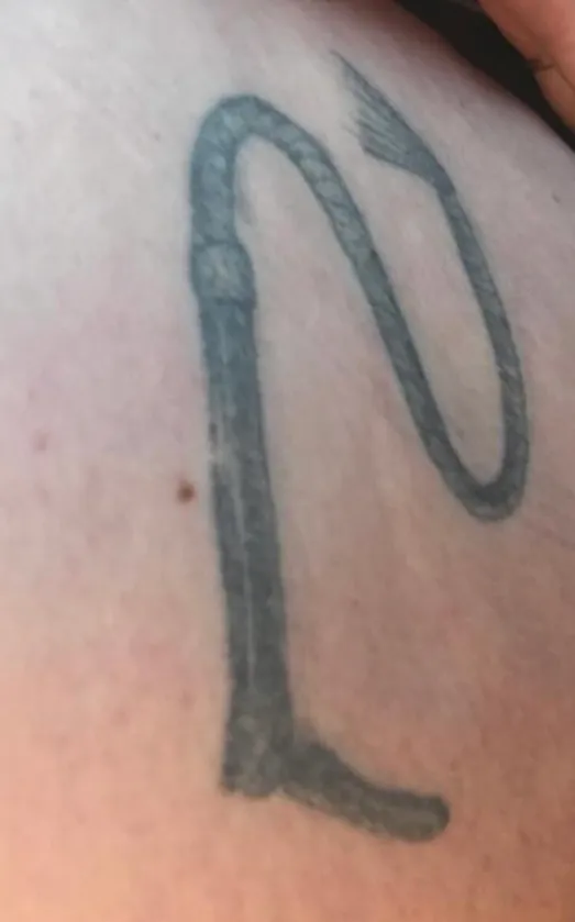 Before - Before and after tattoo removal showing significant fading after 11 sessions