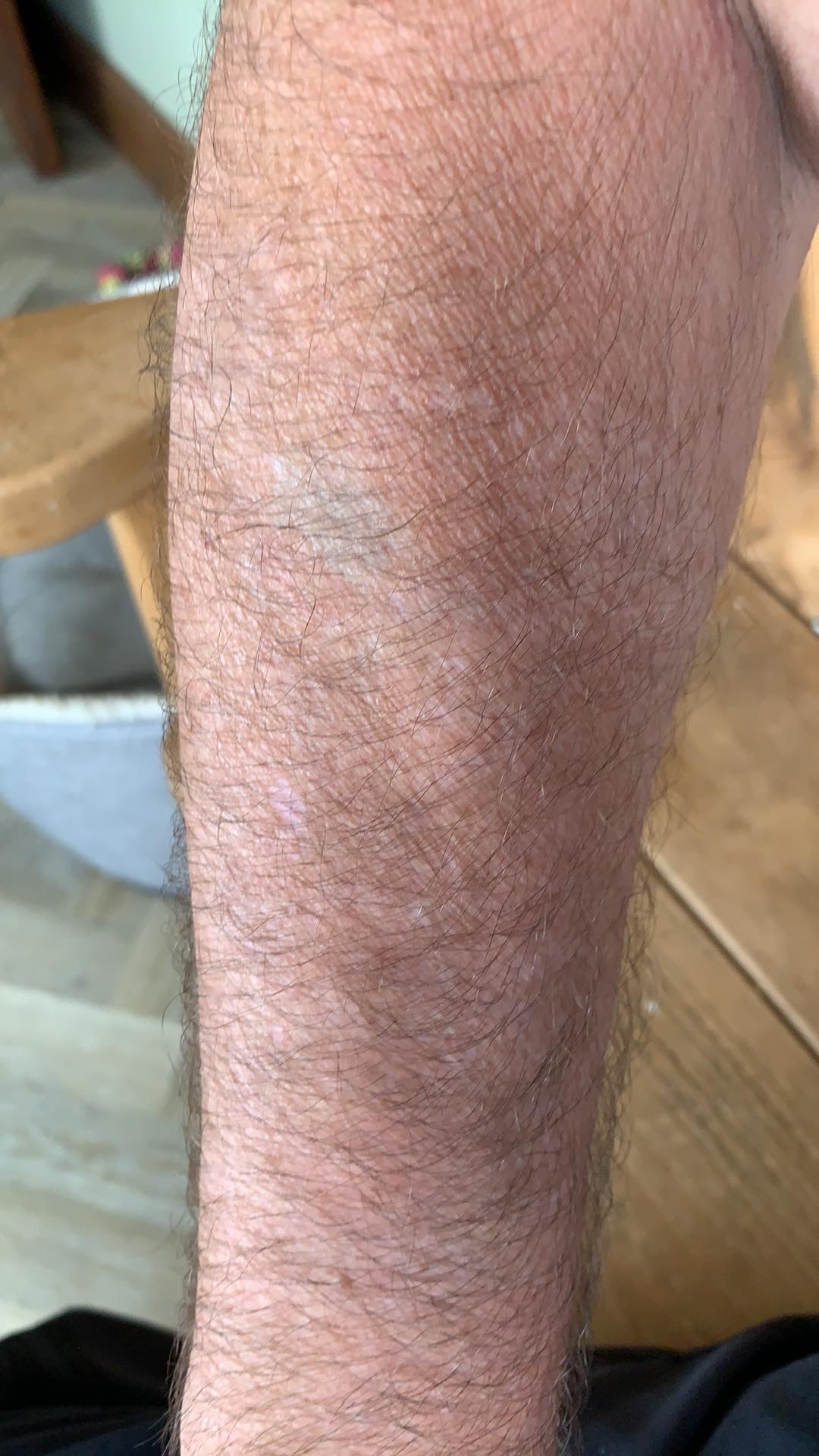 After - Before and after tattoo removal at Mode Laser Skin Clinic showing complete removal