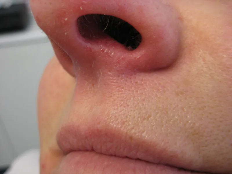 After 2 sessions of IPL capillary removal