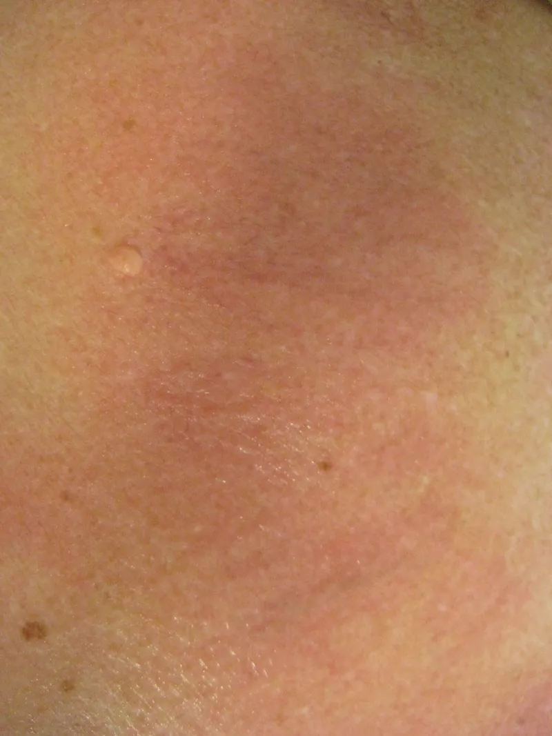 After - Before and after vascular thread vein treatment at Mode Laser Skin Clinic