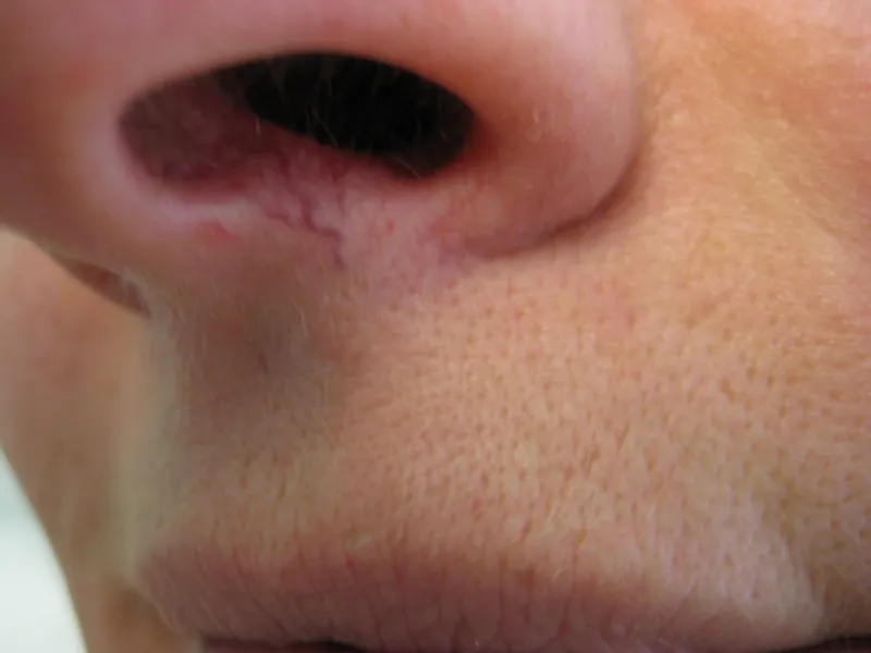Capillaries before removal treatment
