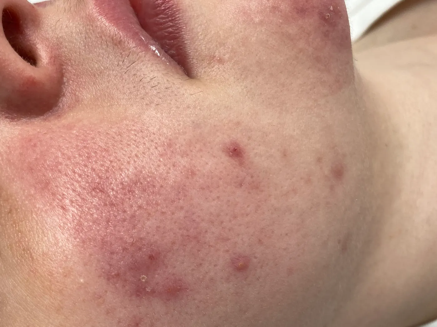 Close-up of rosacea redness on cheek